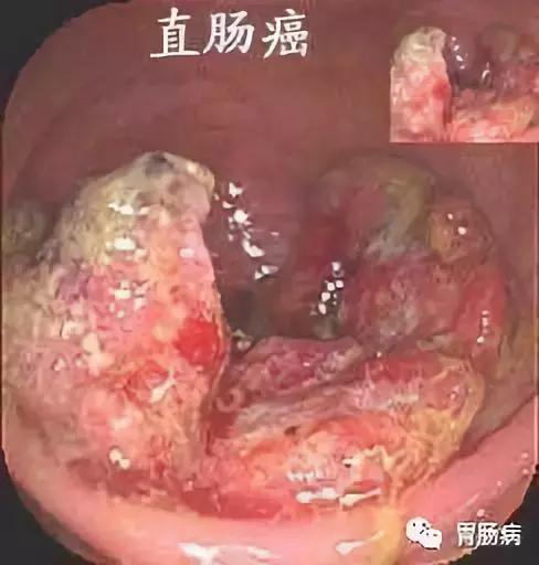 便血是直肠癌的早期吗,便血是直肠癌的前兆吗