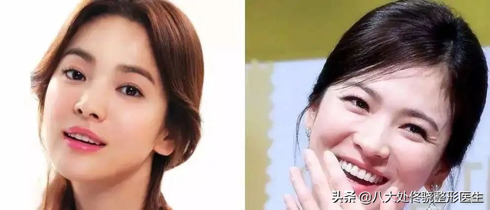 眼窝填充自体脂肪和玻尿酸哪个好,鼻唇沟凹陷物理改善方法