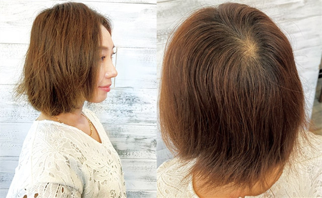 40岁女人头顶脱发严重怎么办,女人头顶有旋头发很少怎么处理