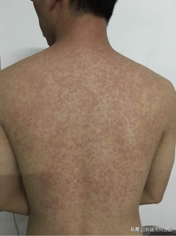 齐多拉米和依非韦伦副作用,hiv药物依非韦伦