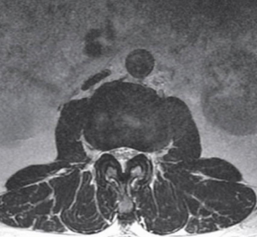 腰椎管狭窄症的基本诊断手段习题,骨科专家讲述腰椎管狭窄的原因