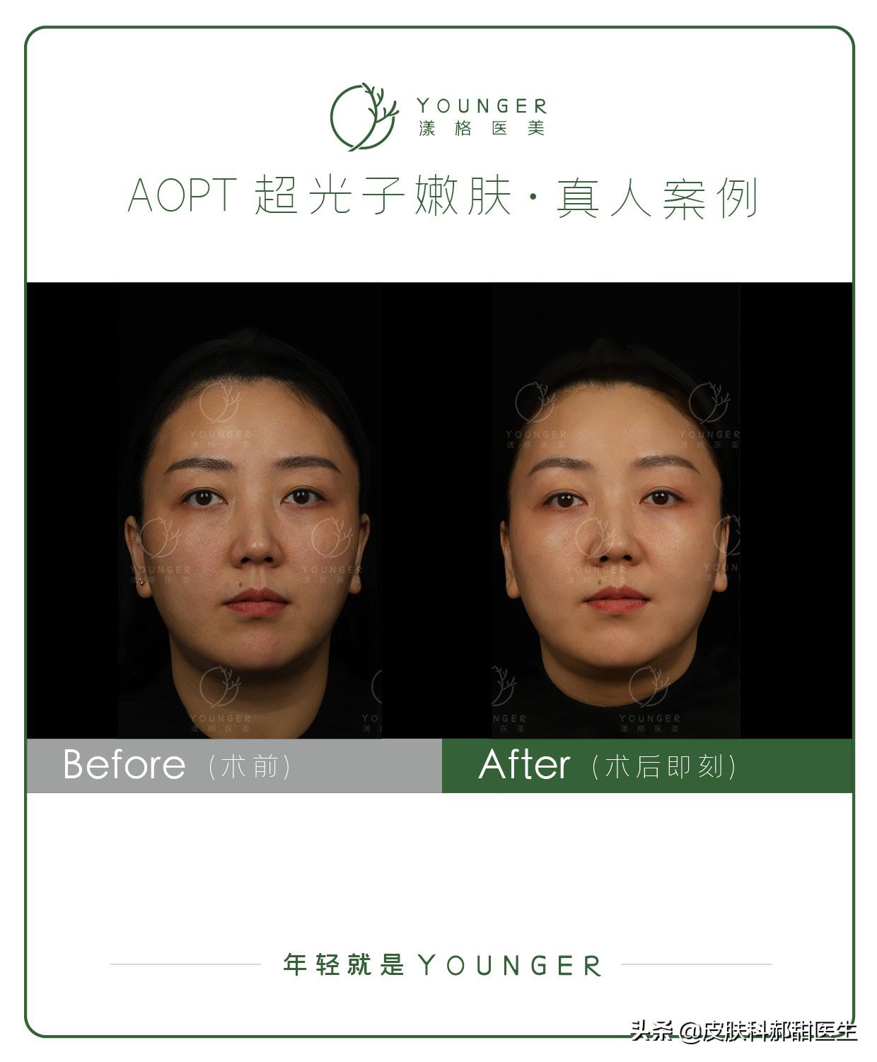 医美初体验光子嫩肤全记录,aopt嫩肤光子