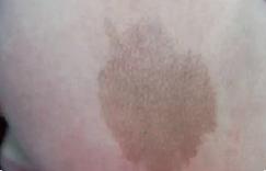 宝宝身上有不光滑胎记,宝宝身上胎记不哭就没有