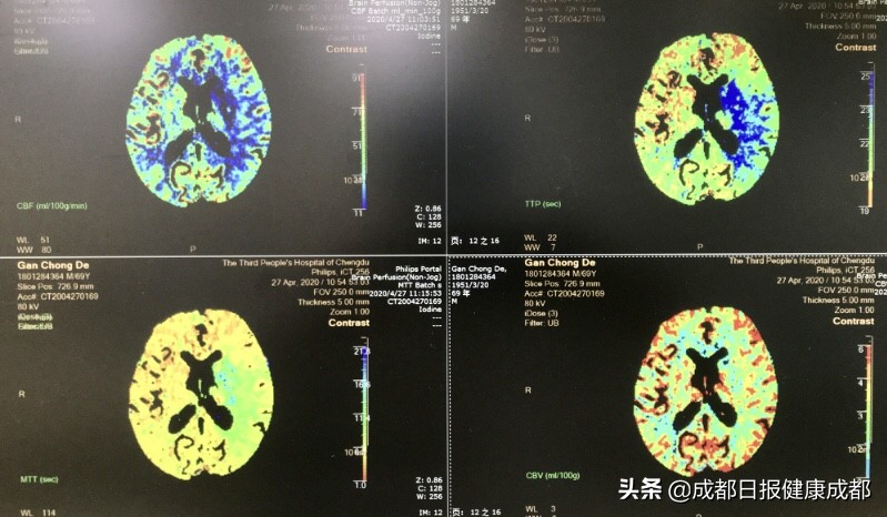 时间就是大脑,脑卒中急救时间窗