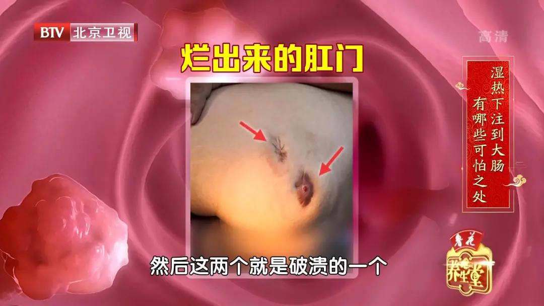 肛门长痔疮用什么中药坐浴,肛门湿热用什么中药坐浴