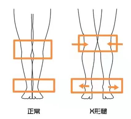 x型腿真的是骨头弯了吗,x型腿是怎么养成的
