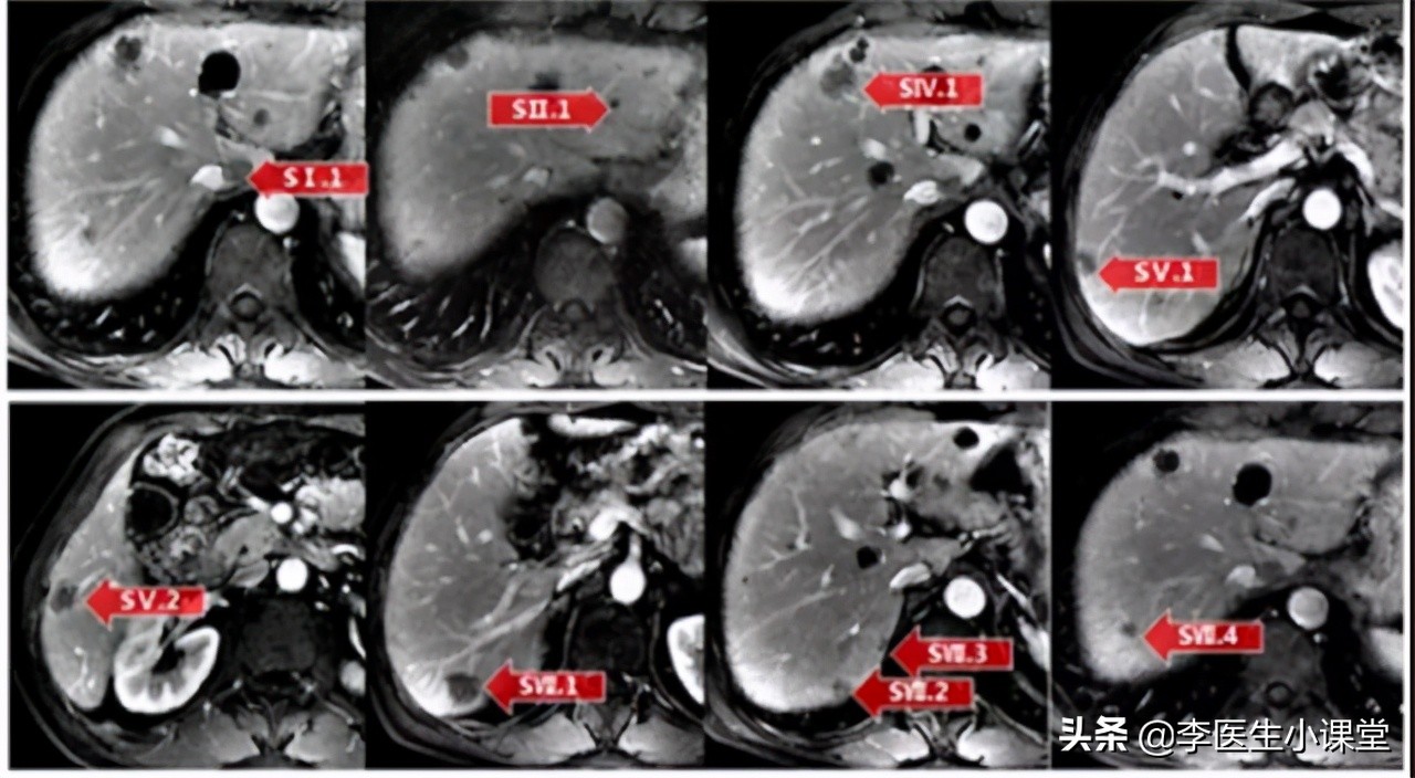 82岁老人便血半年检查肠癌,八十岁老人得肠癌总便血怎么办