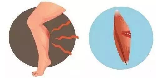 防止小腿肌肉萎缩的康复训练方法,小腿受伤了怎么恢复最快