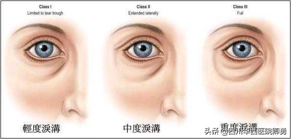 怎么辨别泪沟和眼袋,怎么辨别卧蚕和眼袋