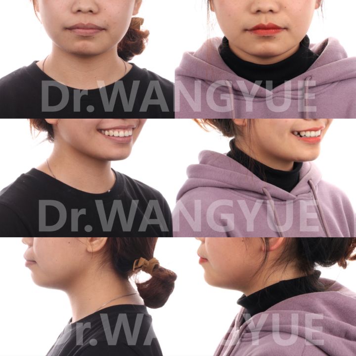 上海舌侧正畸医生,上海舌侧矫正哪家好