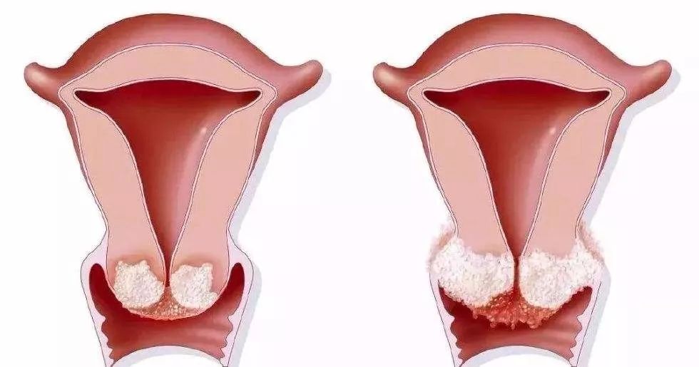 tct和hpv没问题会有宫颈癌吗,从来没做过hpv和tct