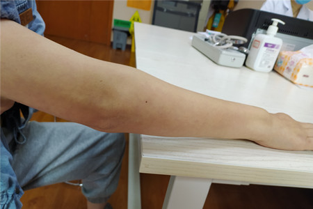 得了类风湿有彻底治愈的案例吗,类风湿治疗要趁早