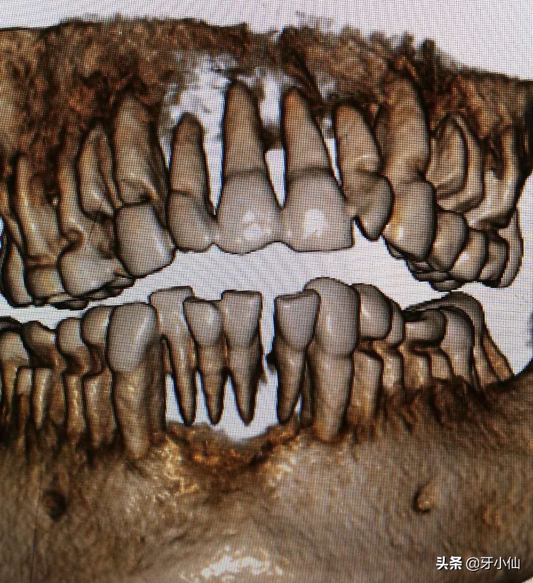 牙龈出血口臭跟牙齿不贴合,有个牙齿晃动牙龈出血口臭