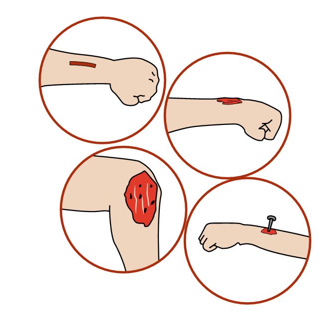 儿童简单外伤的处理方法,如何讲解儿童外伤处理小常识