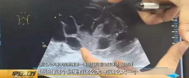 一颗卵子值100,卵子捐卵