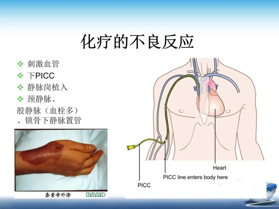 化疗在肿瘤治疗的地位,化疗起到什么作用