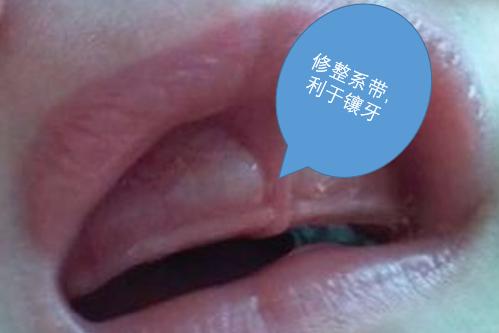 辟谣｜缺牙后直接镶上就好，NO,口腔医生说镶牙前还需要做这些准备