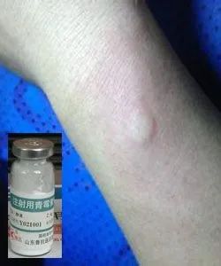 青霉素可以治哪些病,青霉素用药需要注意什么