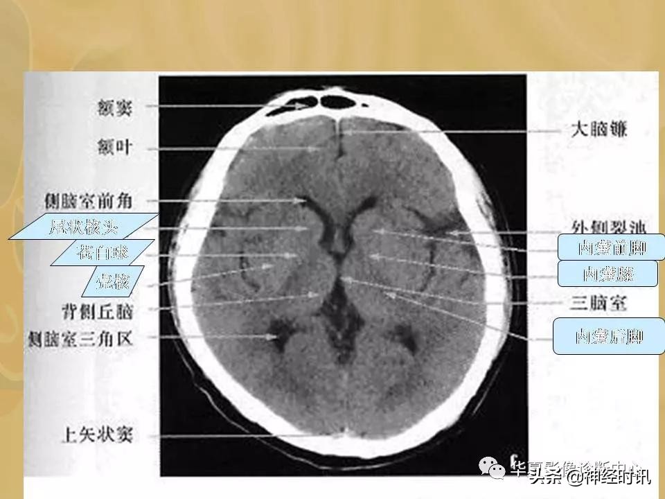 基底节ct解剖示意图,影像解剖图谱怎么用
