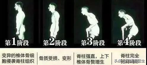 免疫相关不良妊娠答疑解惑,怀孕如何避免强直性脊柱炎