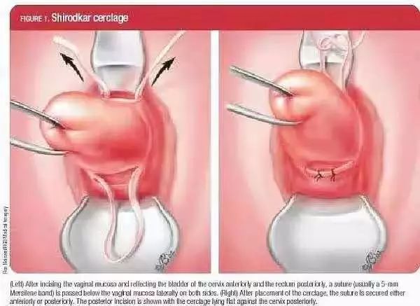 孕21周做宫颈环扎术成功率有多少,孕前腹腔镜宫颈环扎术过程及弊端
