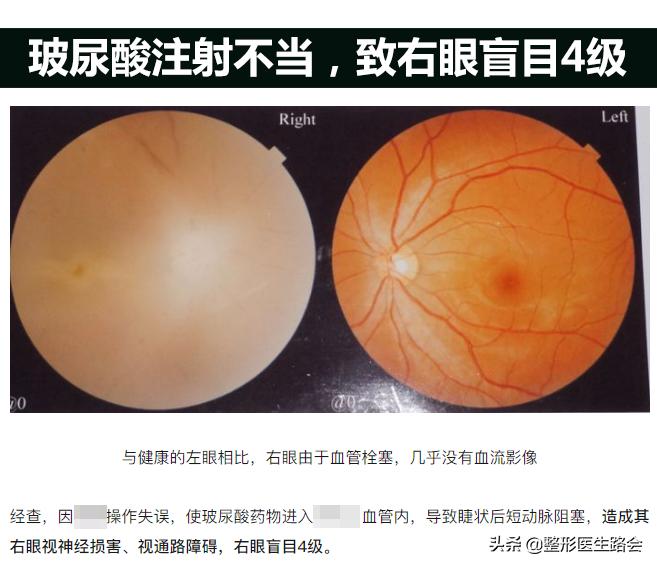 玻尿酸填泪沟为什么不吸收,玻尿酸填泪沟的好处和坏处