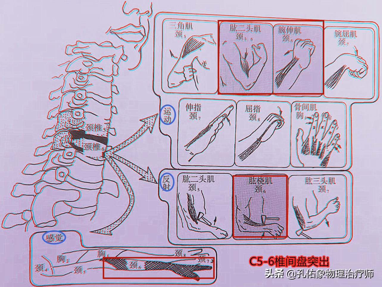 颈椎间盘突出手指尖麻乏力怎么治,颈椎间盘突出导致四肢无力疼痛