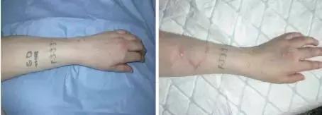 纹身的激光治疗,激光能祛纹身吗