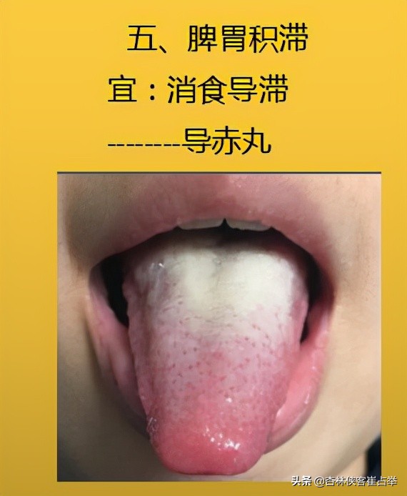 生理性齿痕舌与病理性齿痕舌,齿痕舌形成的原因是脾虚还是瘀血