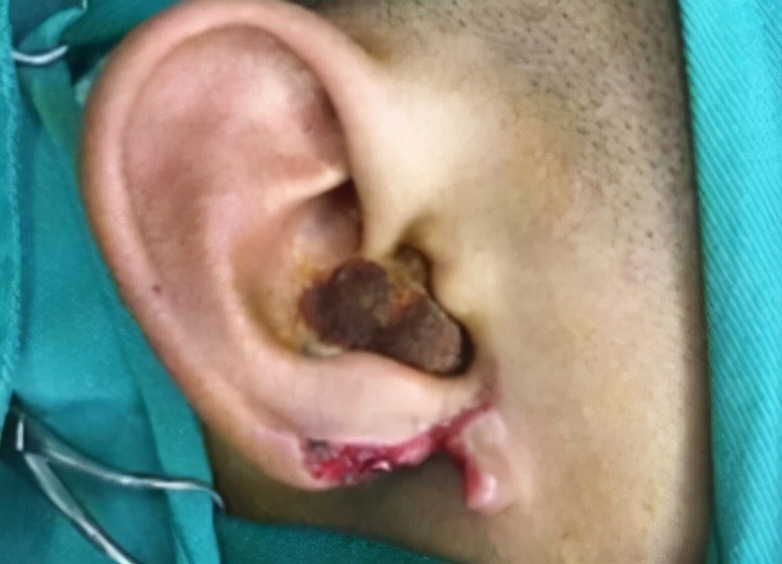 耳垂畸形多大可以手术,耳垂畸形是什么原因导致的