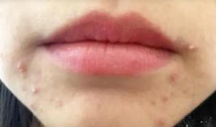 胃火旺盛的症状和调理方法,中医针灸泻胃火最快方法