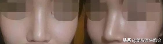 玻尿酸填充鼻梁一次会变宽吗,玻尿酸隆鼻会让鼻梁变宽吗