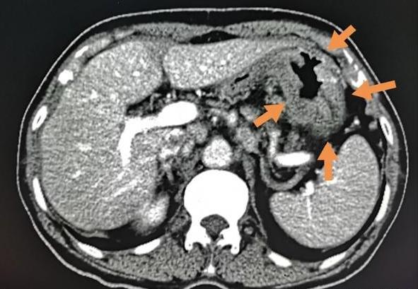 肚子老是咕噜咕噜响是肠癌表现吗,肚子咕噜咕噜响胀气是怎么回事