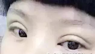 男生割内双眼皮手术,男子去割单眼皮后的结果