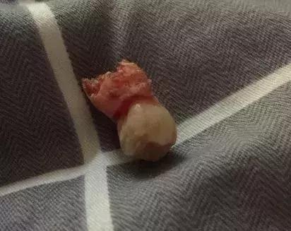 为什么拔智齿那么疼,为什么拔智齿会痛这么久