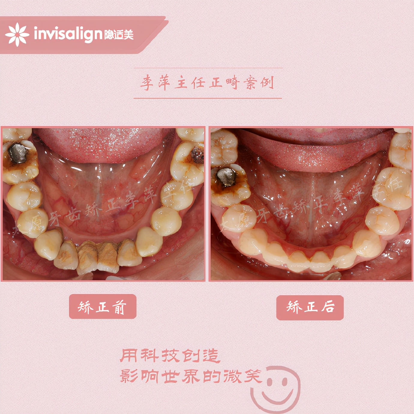 成都牙齿有缝隙怎么矫正,牙齿拥挤矫正前两天不痛正常吗