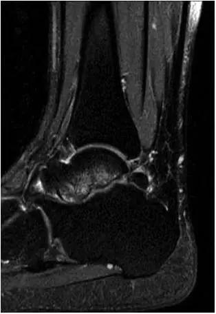 踝关节撞击症问诊,踝关节撞击综合征的x线表现