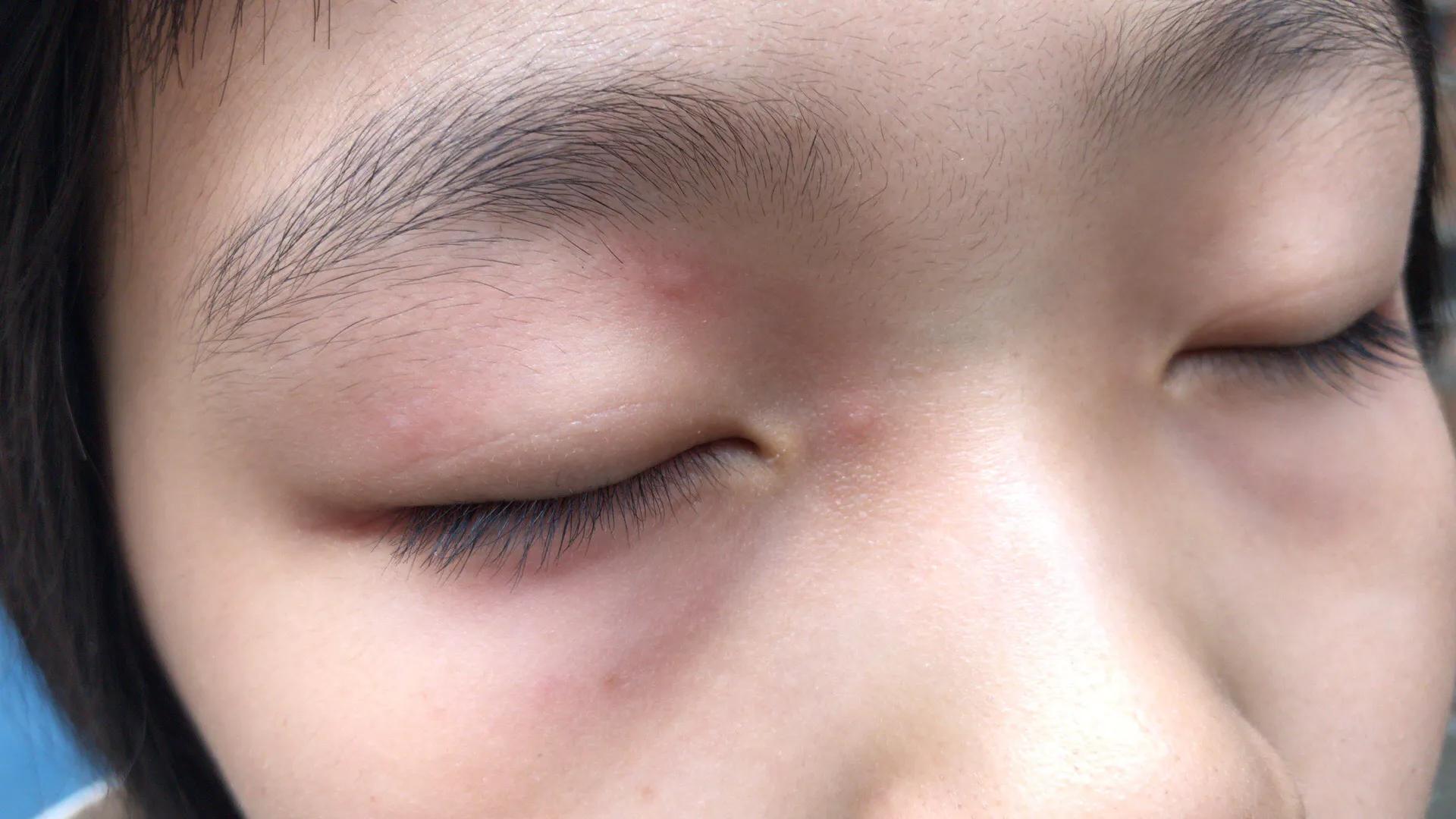 儿童发烧吃美林过敏什么原因,儿童发烧喝美林浑身起疙瘩