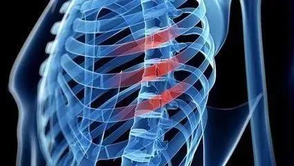 肋骨骨折三根保守治疗赔偿2万吗,肋骨骨折手术好还是保守治疗好