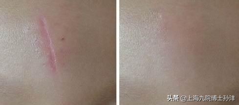 激光祛疤后疤痕变黑是什么原因,3厘米的疤痕激光祛疤手术多少钱