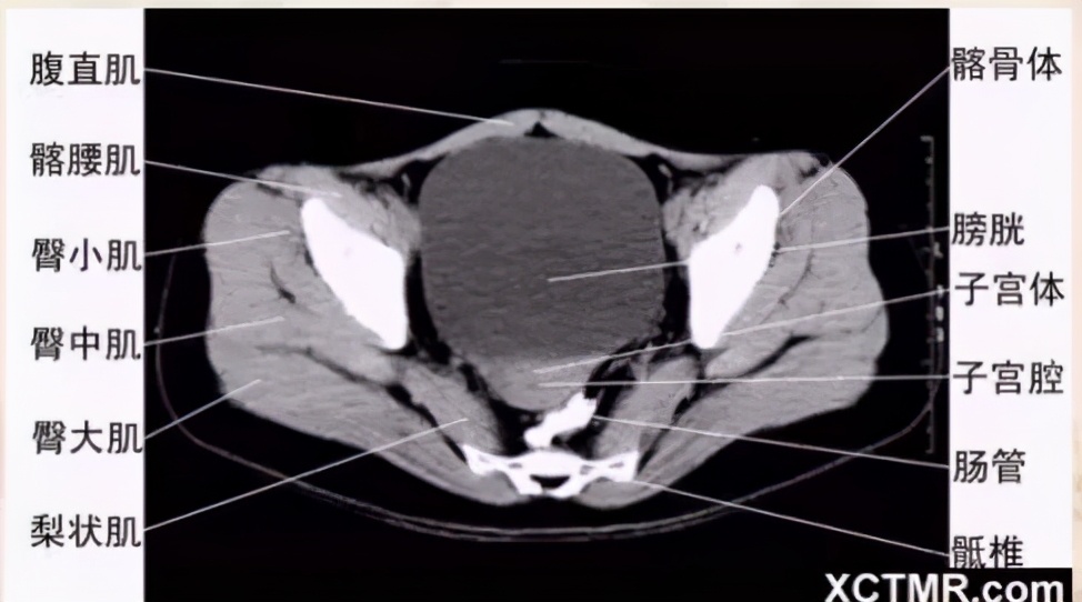 女性盆腔ct断层解剖结构图,女性盆腔脏器ct解剖