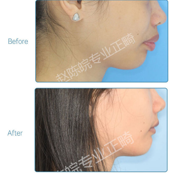 杭州牙齿矫正的全过程,杭州牙齿矫正哪个医生最好