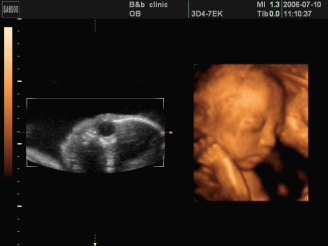 怀孕六个月宝宝四维图片大全,四维胎儿鼻子嘴都大很丑正常吗