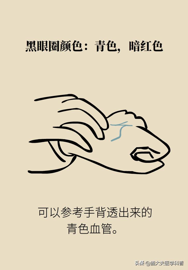 医生黑眼圈,手术消除黑眼圈靠谱吗