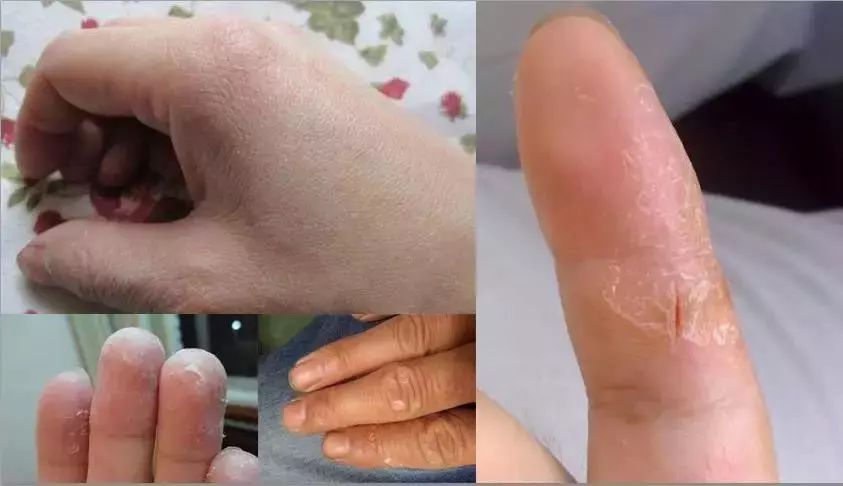 手脚干裂倒刺怎么治疗,手脚经常脱皮开裂最佳治疗方法