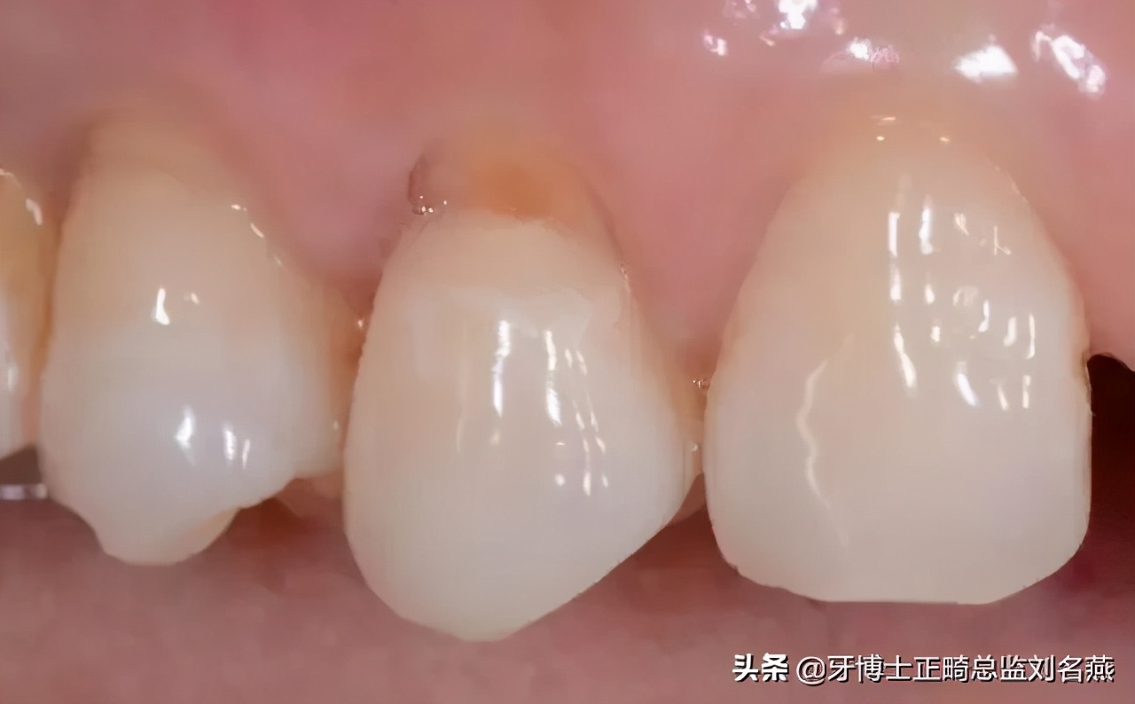 楔状缺损怎么修补,楔状缺损充填视频