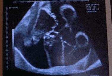 39周胎儿求救前兆有哪些,孕26周胎儿死在腹中有什么反应