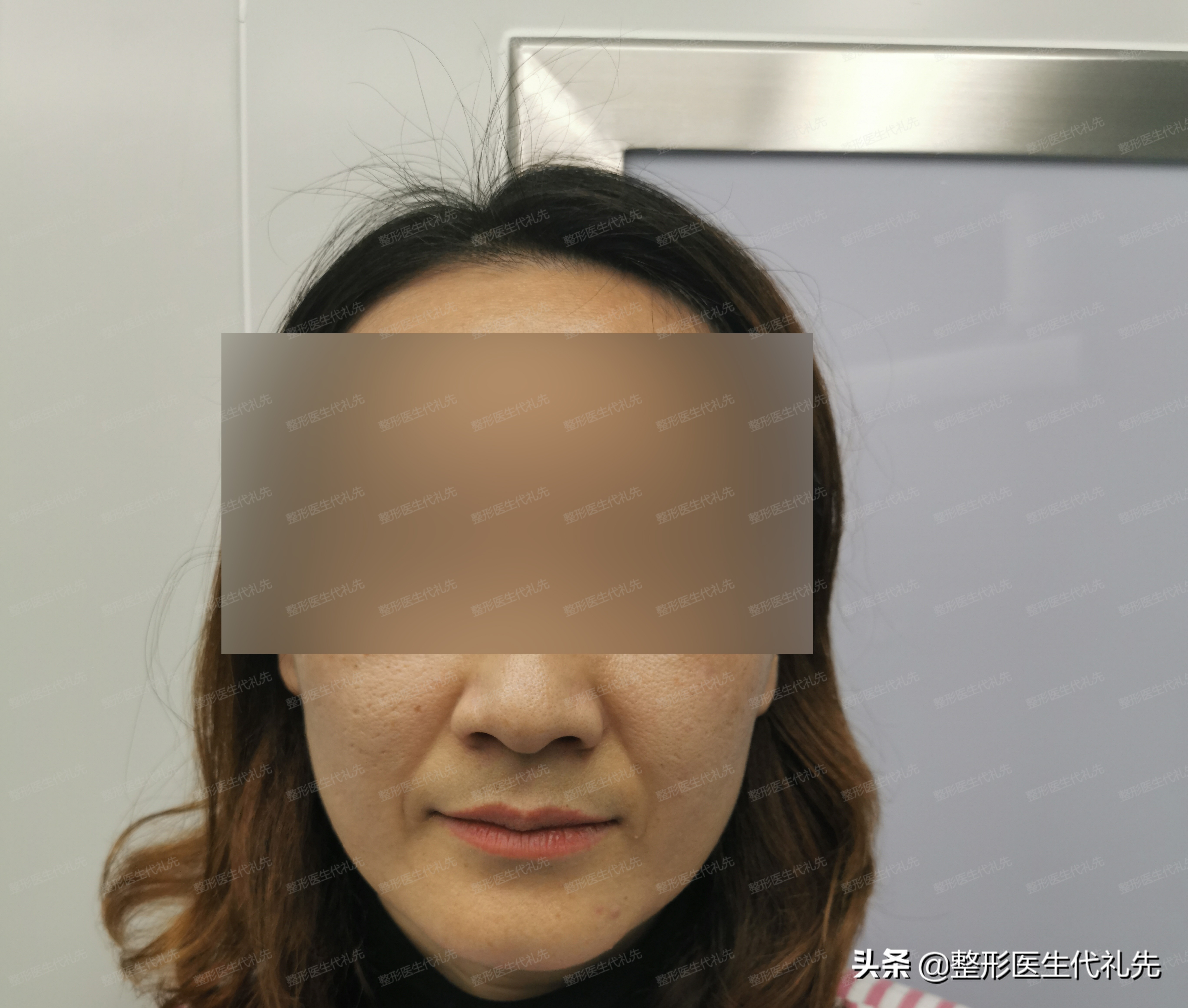 从整形医生的角度讲解,法令纹到底怎么能彻底解决