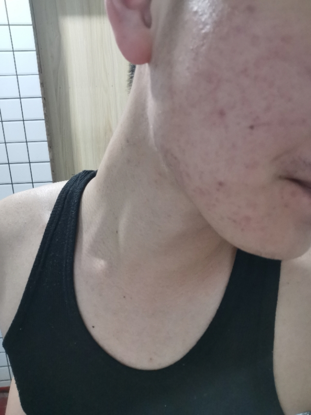 痘印黑色素沉淀怎么去除,痘印怎么去除最快最好方法