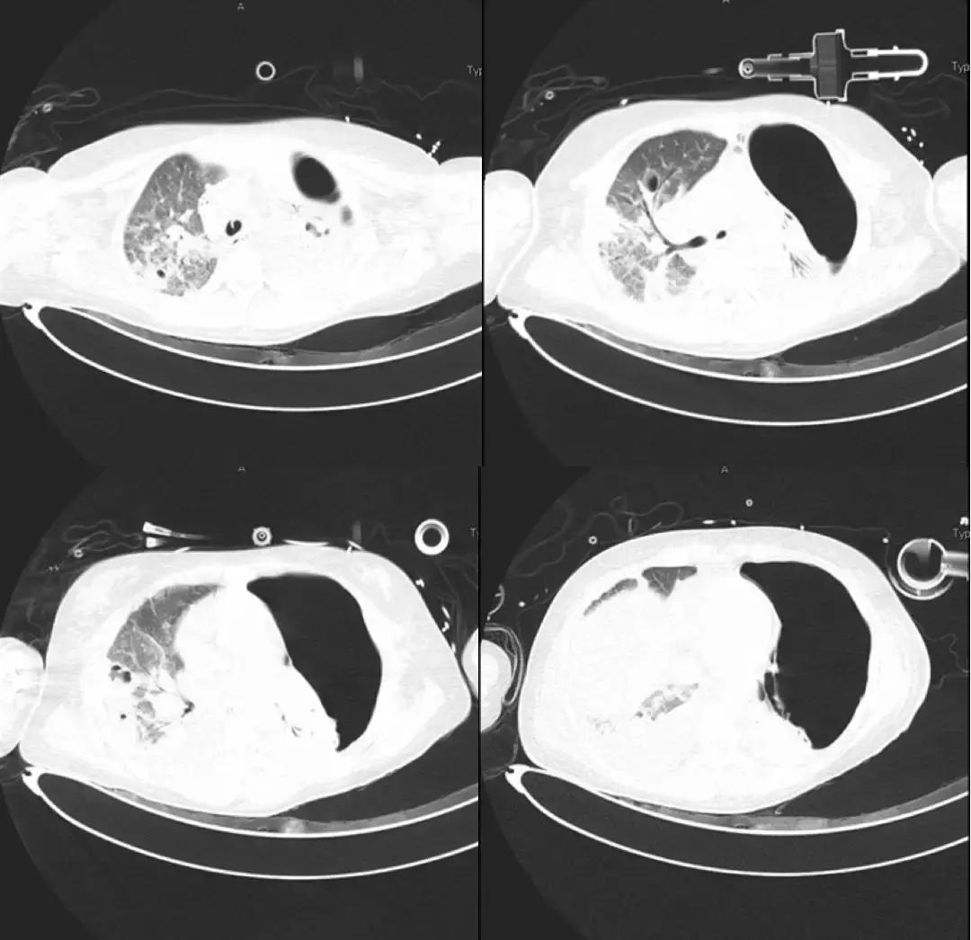 万古霉素治疗mrsa疗程,万古霉素用于mrsa的作用机制